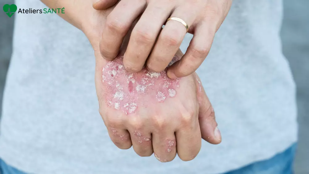 cbd et psoriasis